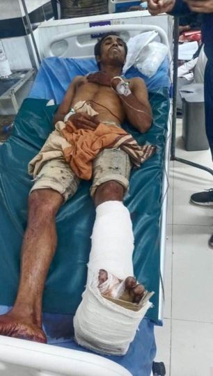 নাইক্ষ্যংছড়ি সীমান্তে স্থলমাইন বিস্ফোরণে কাঠুরিয়া গুরুতর আহত