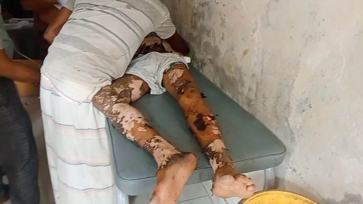 লোহাগড়ায় বিদ্যুতের তারে জড়িয়ে শ্রমিকের শরীর ঝলশে মৃত্যুর সঙ্গে পাঞ্জা লড়ছে।